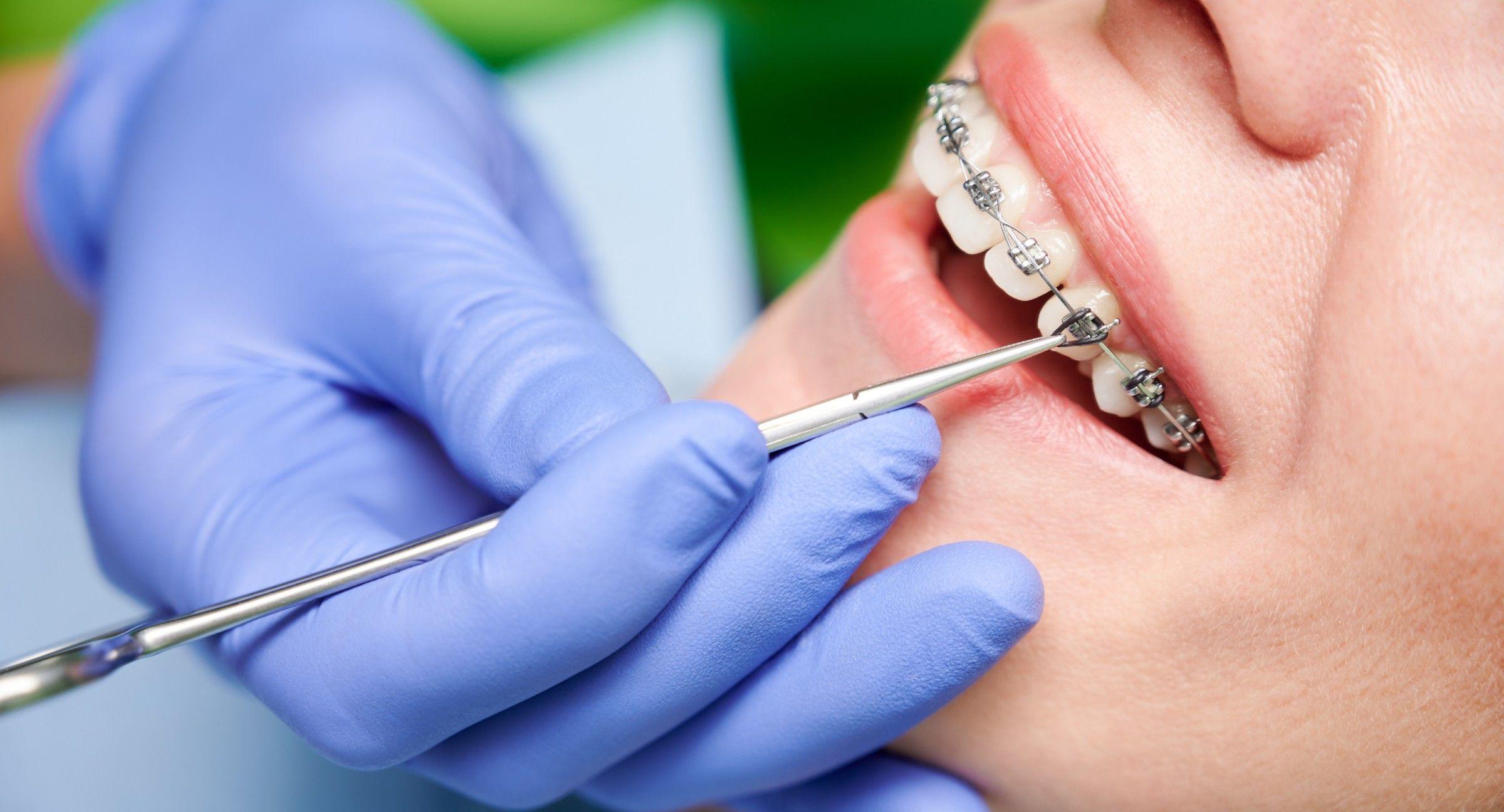 Orthodontic Treatment